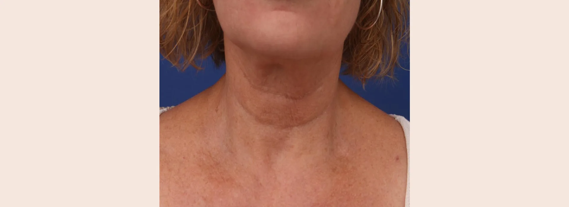 skin firming treatments result on a women neck