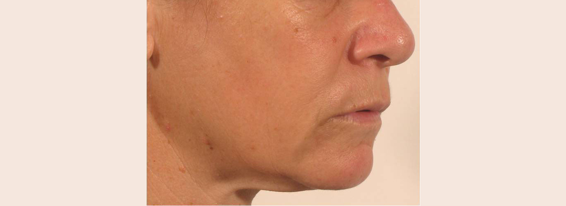 Legend before and after pics - skin tightening therapy