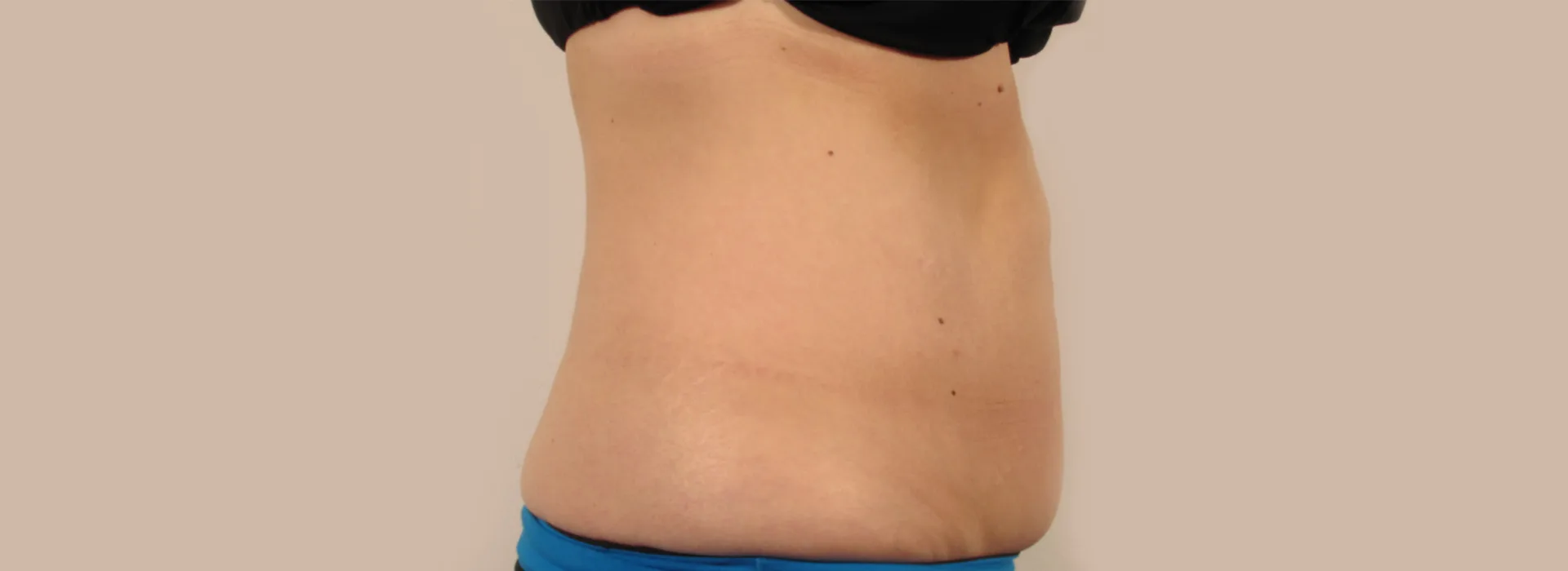 maximus body sculpting device results before and after