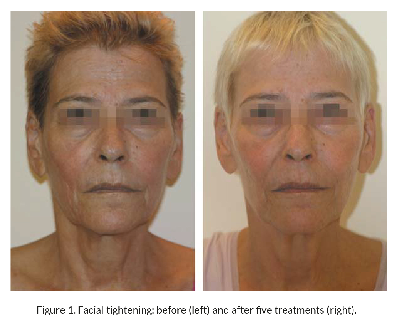 before and after tripollar rf skin treatments