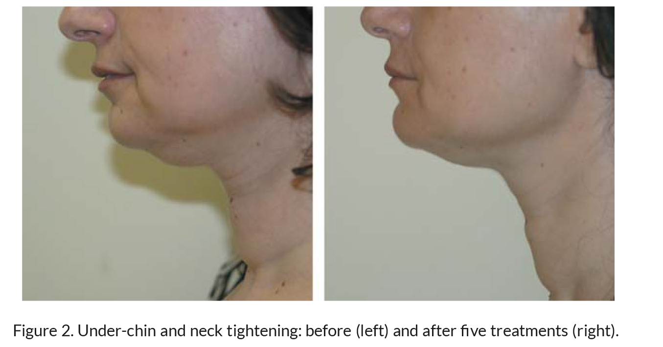 before and after tripollar neck tightening treatments